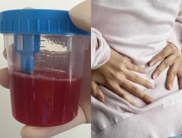 Συμπτώματα που μπορεί να δείχνουν καρκίνο στην ουροδόχο κύστη