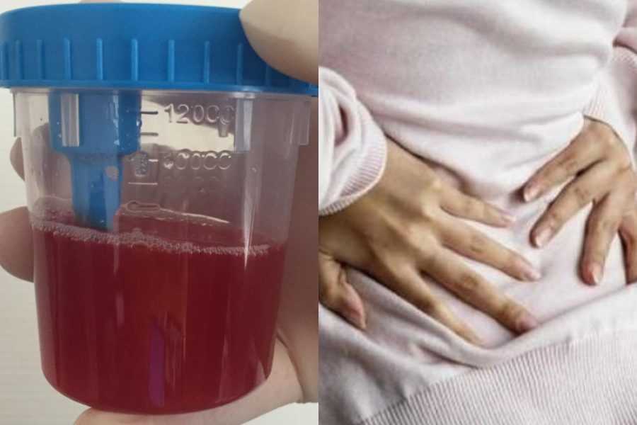 Συμπτώματα που μπορεί να δείχνουν καρκίνο στην ουροδόχο κύστη