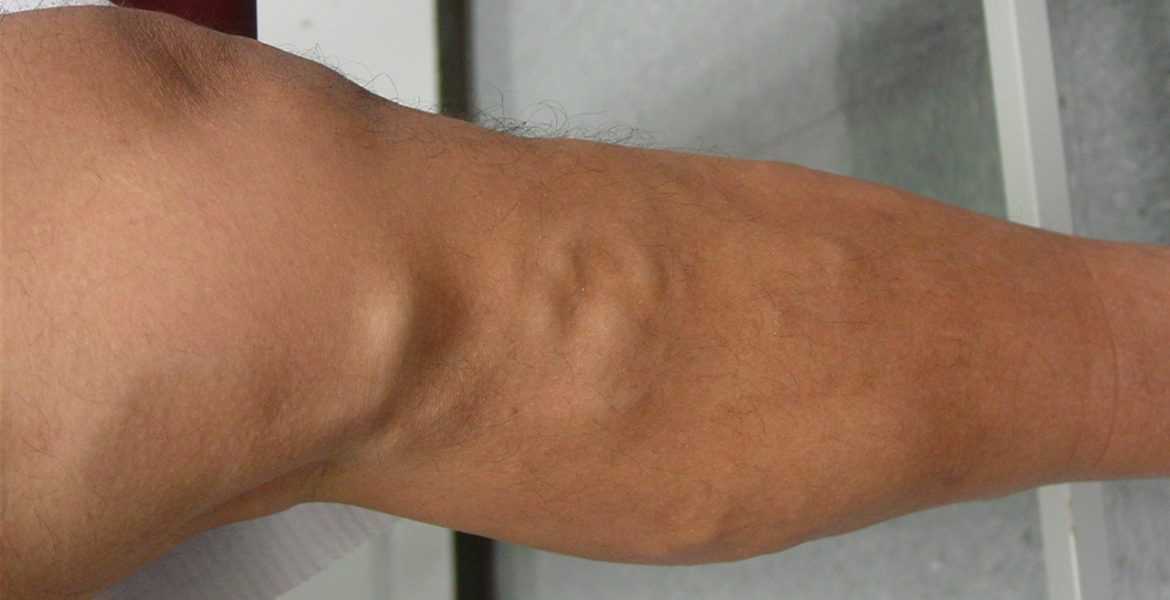 Πως να απαλλαγείτε από την φλεβίτιδα φυσικά και ανέξοδα