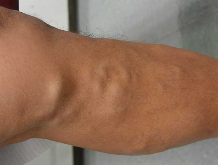 Πως να απαλλαγείτε από την φλεβίτιδα φυσικά και ανέξοδα