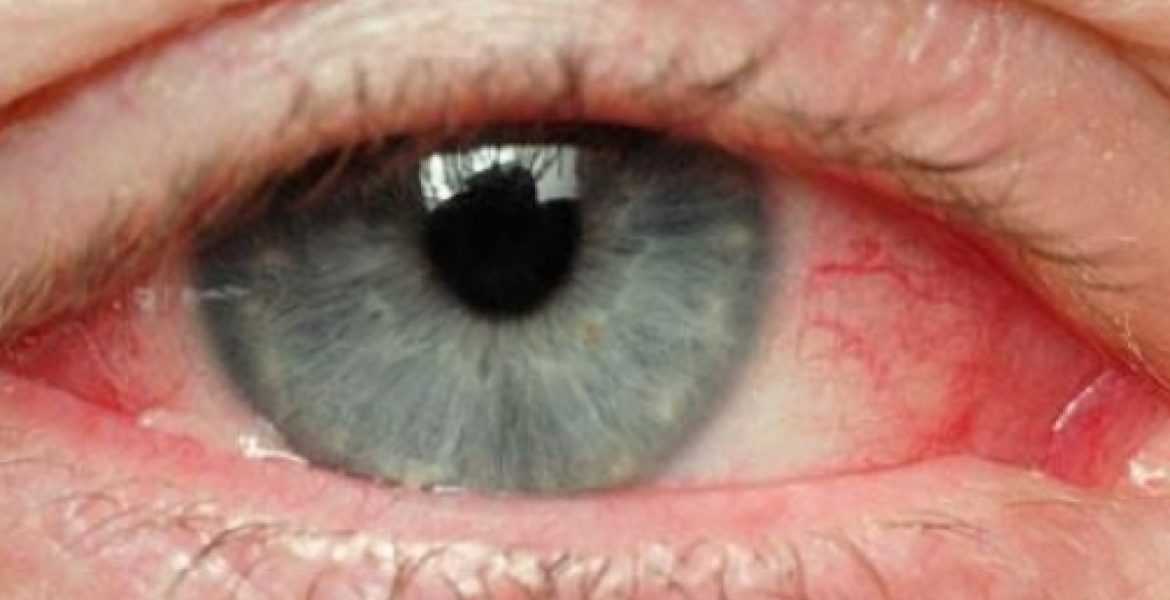 Πέντε σημάδια που δείχνουν πως ίσως να έχετε πρόβλημα στα μάτια