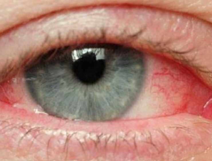 Πέντε σημάδια που δείχνουν πως ίσως να έχετε πρόβλημα στα μάτια