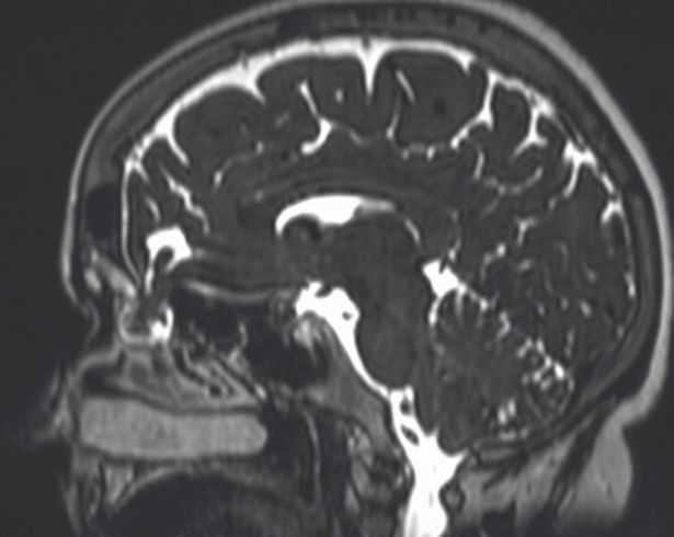 Κορονοϊός: Γυναίκα έκανε ρινικό τεστ και της τρύπησαν τον εγκέφαλο