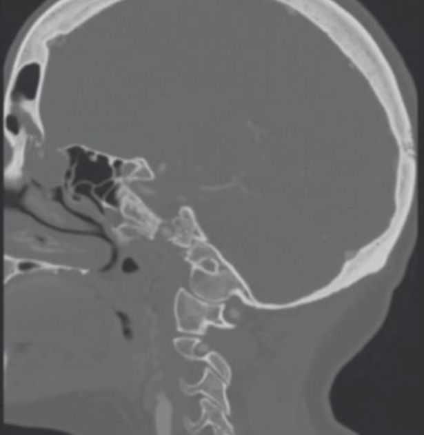 Κορονοϊός: Γυναίκα έκανε ρινικό τεστ και της τρύπησαν τον εγκέφαλο